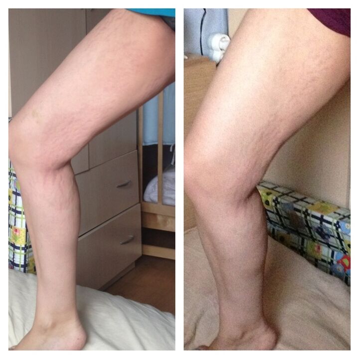 knee before and after
